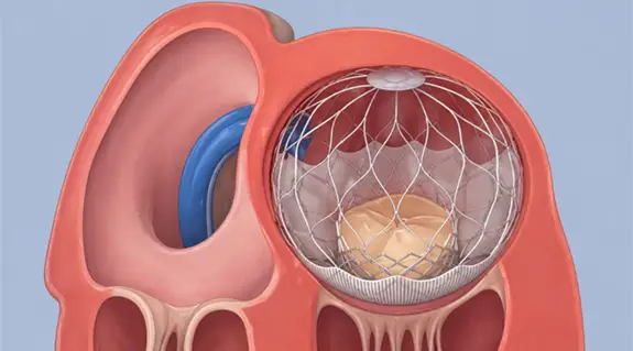 altavalve treatment