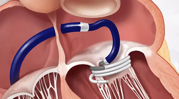 Edwards Sapien M3 Procedure diagram